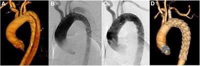 Treatment for Stanford type B aortic dissection with insufficient anchoring region using castor integrated branched aortic stent graft